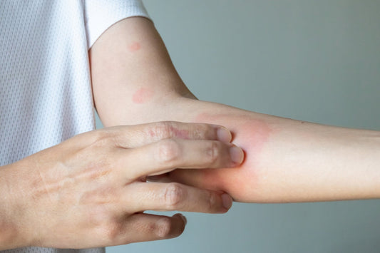 Natural Alternatives to Steroids for Eczema & Psoriasis | Risks of Topical Steroid Withdrawal (TSW)