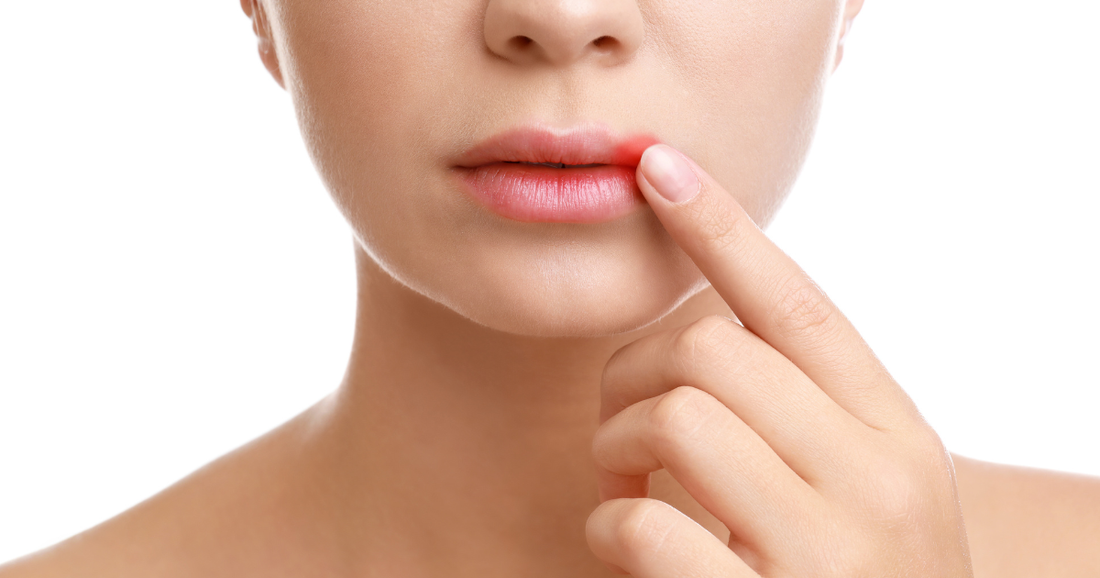 Cold Sores Explained: Causes, Stages, Triggers and What to Do at the First Tingle