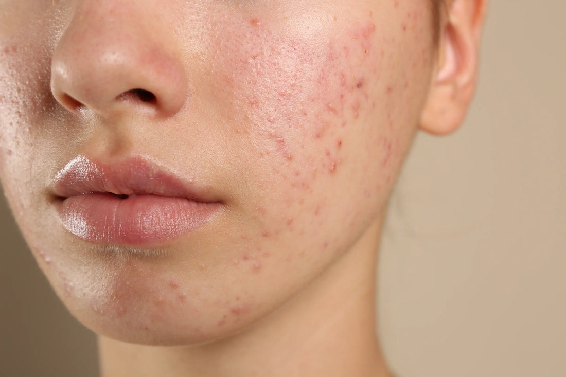 Best Spot Cream UK: What to Look for in a Cream for Spots & Pimples - Stinky Stuff
