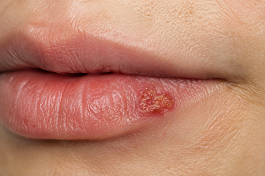 Cold Sore