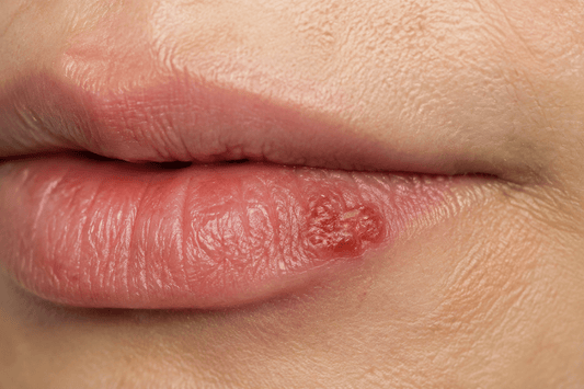 Cold Sores Explained: Causes, Stages, Triggers and What to Do at the First Tingle - Stinky Stuff