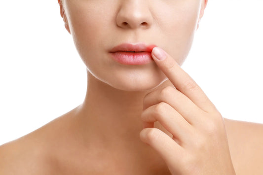 Cold Sores Explained: Causes, Stages, Triggers and What to Do at the First Tingle - Stinky Stuff
