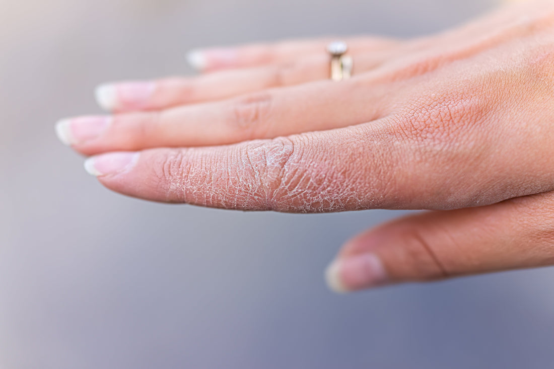 How Winter Affects Our Skin - Stinky Stuff