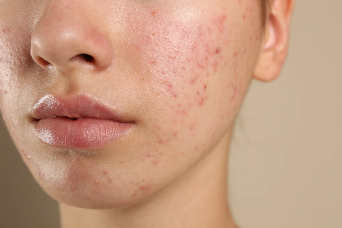 Best Spot Cream UK: What to Look for in a Cream for Spots & Pimples