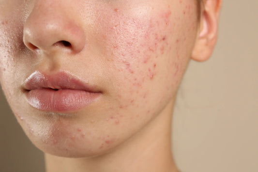Best Spot Cream UK: What to Look for in a Cream for Spots & Pimples