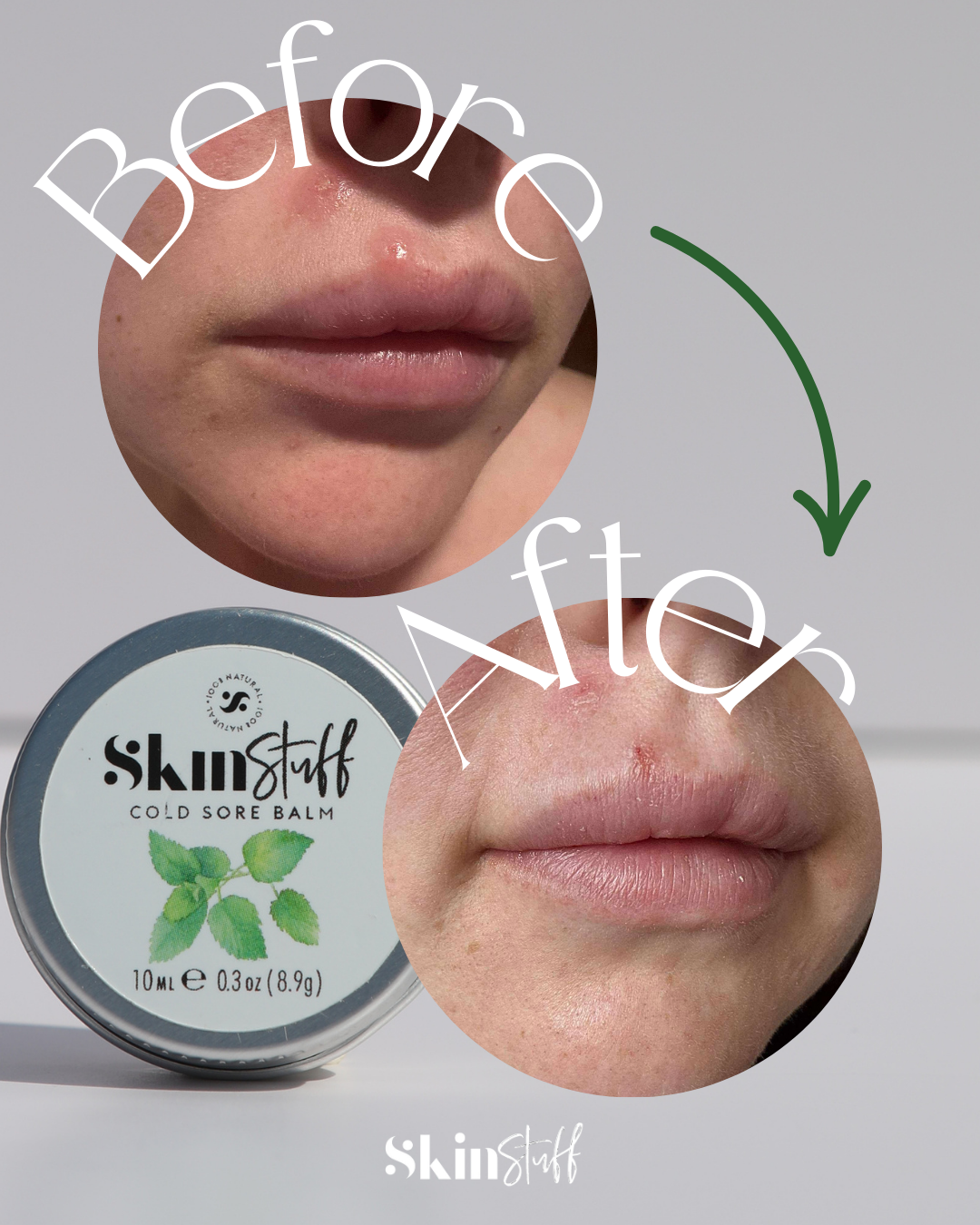 Cold Sore Balm BUY 1 GET 1 FREE TODAY