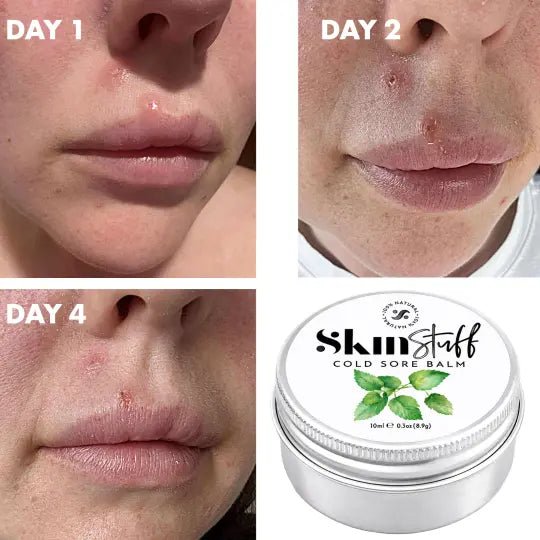 Cold Sore Balm - 100% Natural Cold Sore Remedy - Stinky Stuff
