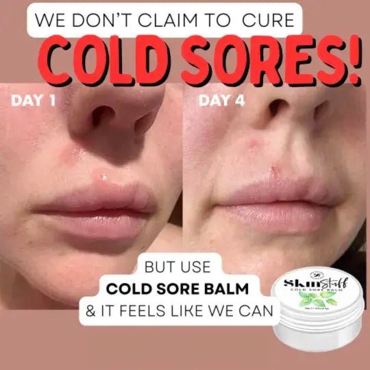Cold Sore Balm - 100% Natural Cold Sore Remedy - Stinky Stuff