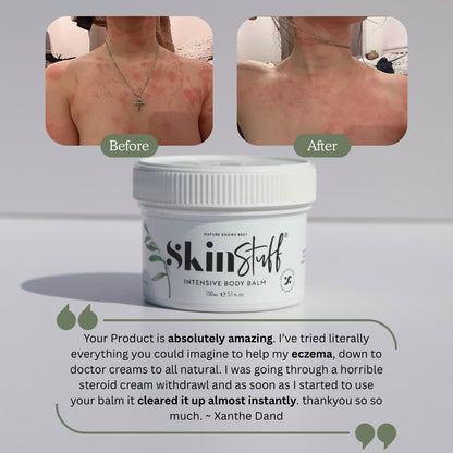 Natural Relief For Dry, Itchy & Sensitive Skin - Stinky Stuff