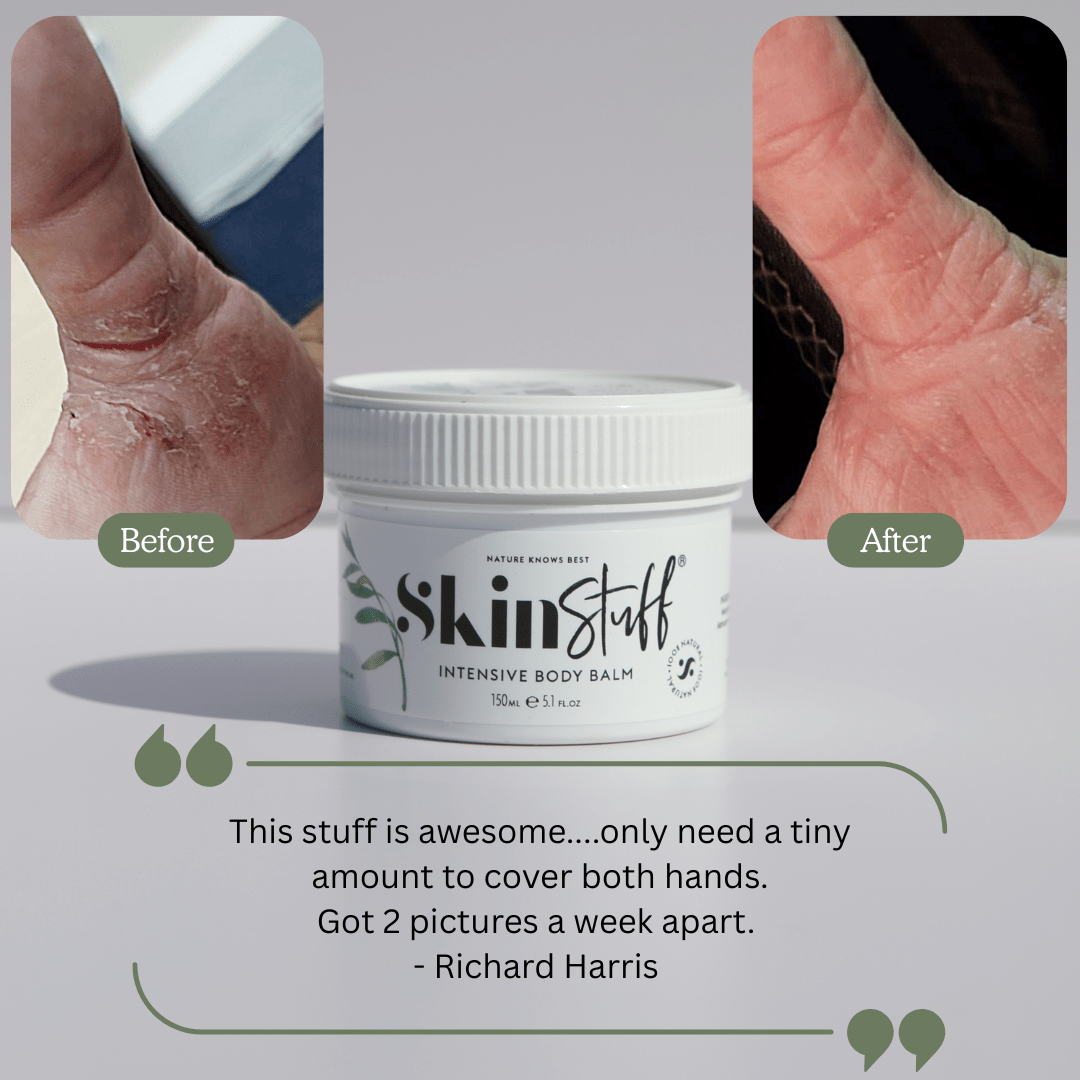 Natural Relief For Dry, Itchy & Sensitive Skin - Stinky Stuff