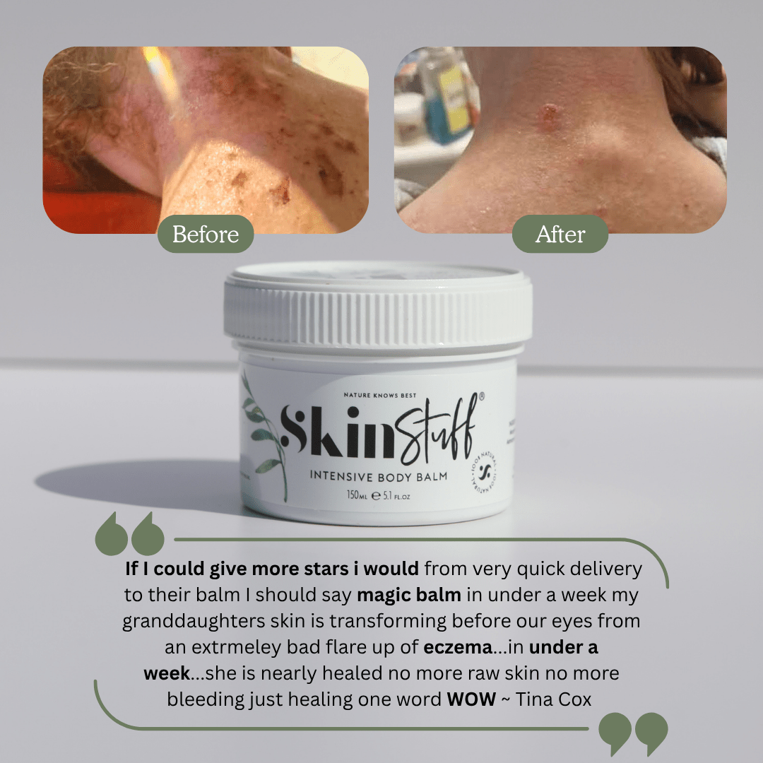 Natural Relief For Dry, Itchy & Sensitive Skin - Stinky Stuff