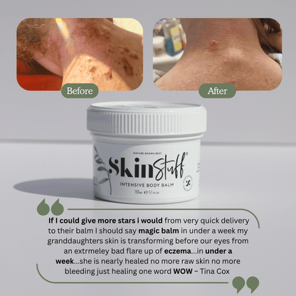 Natural Relief For Dry, Itchy & Sensitive Skin - Stinky Stuff