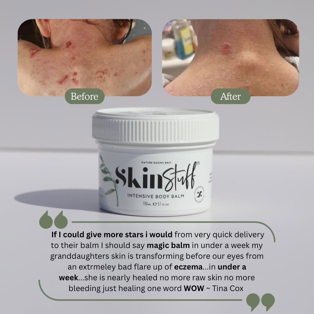 Natural Relief For Dry, Itchy & Sensitive Skin - Stinky Stuff