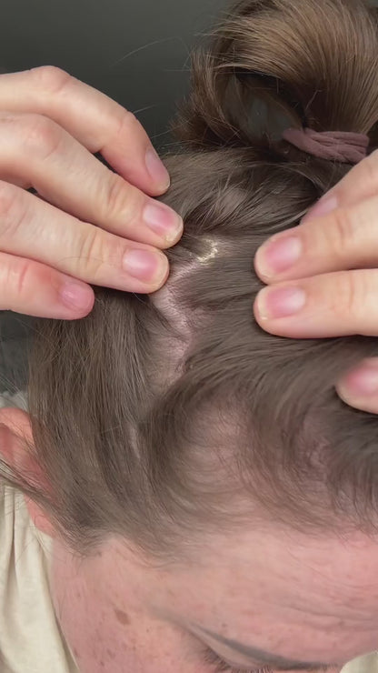 Natural Relief for Dry, Itchy Scalps