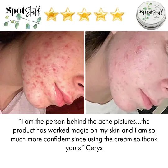 Spot Stuff - 100% Natural Spot Cream - Stinky Stuff